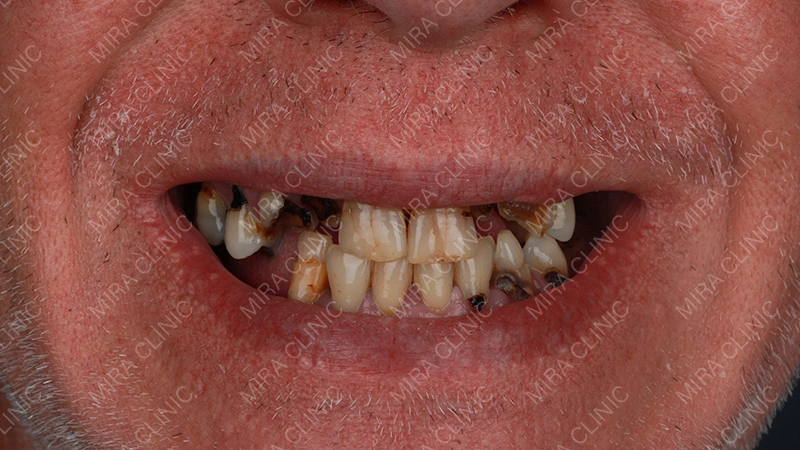 Patient Background: Years of Dental Problems and Tooth Loss